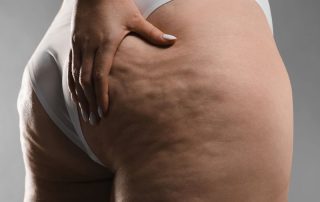 What is Cellulite