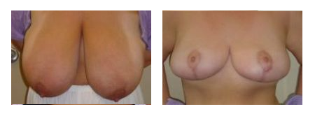 Breast Reduction in Jacksonville