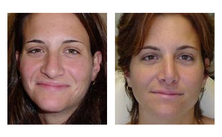 Nose Surgery in Jacksonville by Dr. David N. Csikai