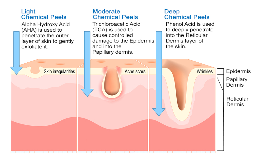 The Penetrating Depth of Different Chemical Peels