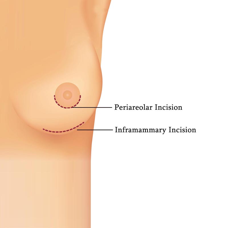 Breast Augmentation in Jacksonville